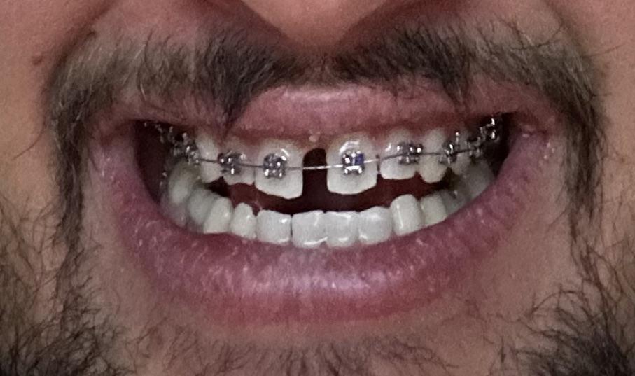 How much do Braces Hurt on a Scale 1-10